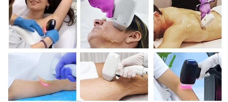 laser diode hair removal