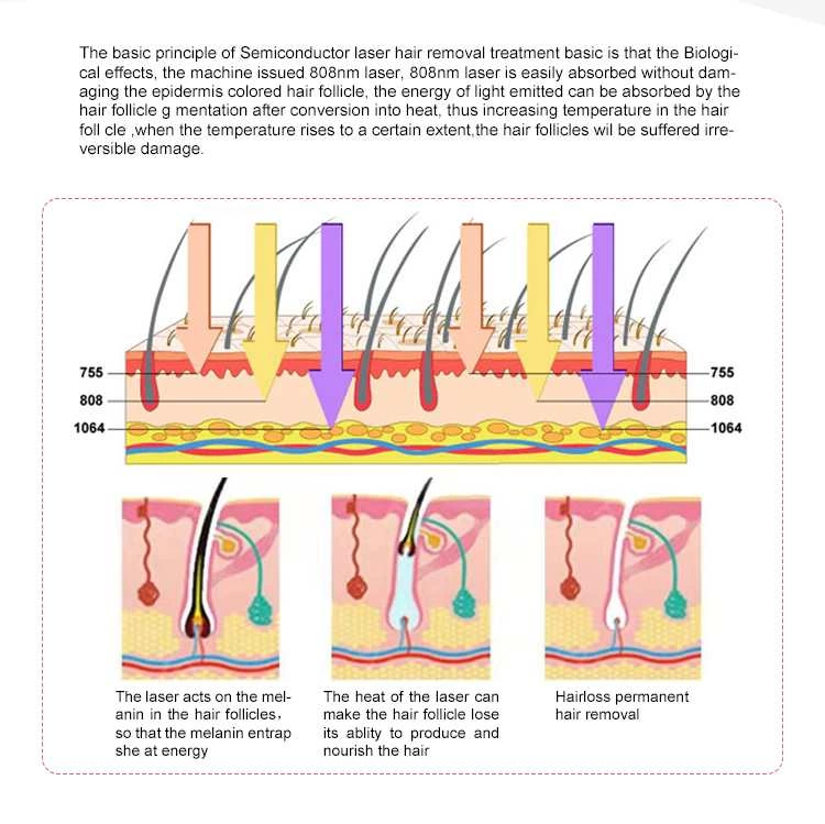 laser hair removal machine price