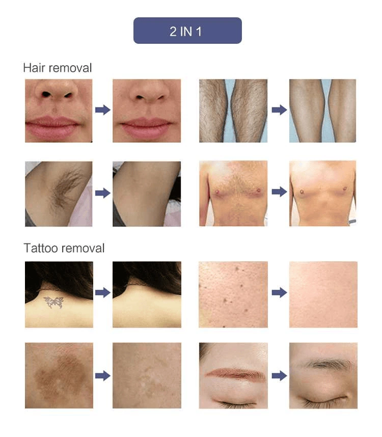 hair removal machine laser