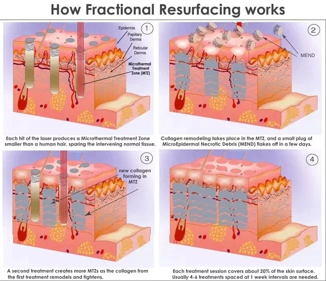 fractional co2 laser