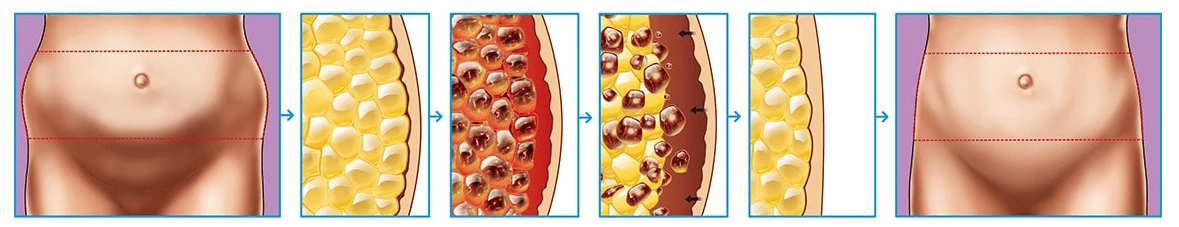 cellulite reduction machines