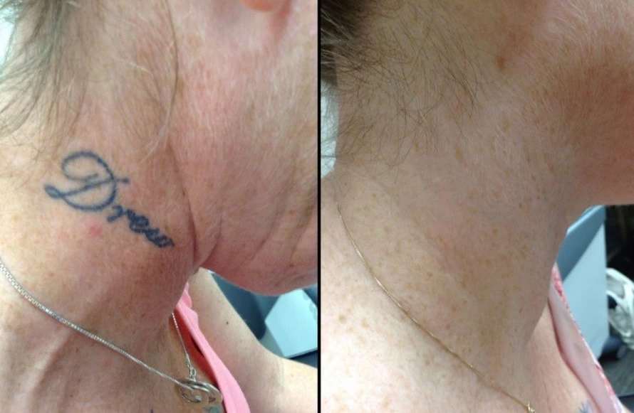 laser tattoo removal