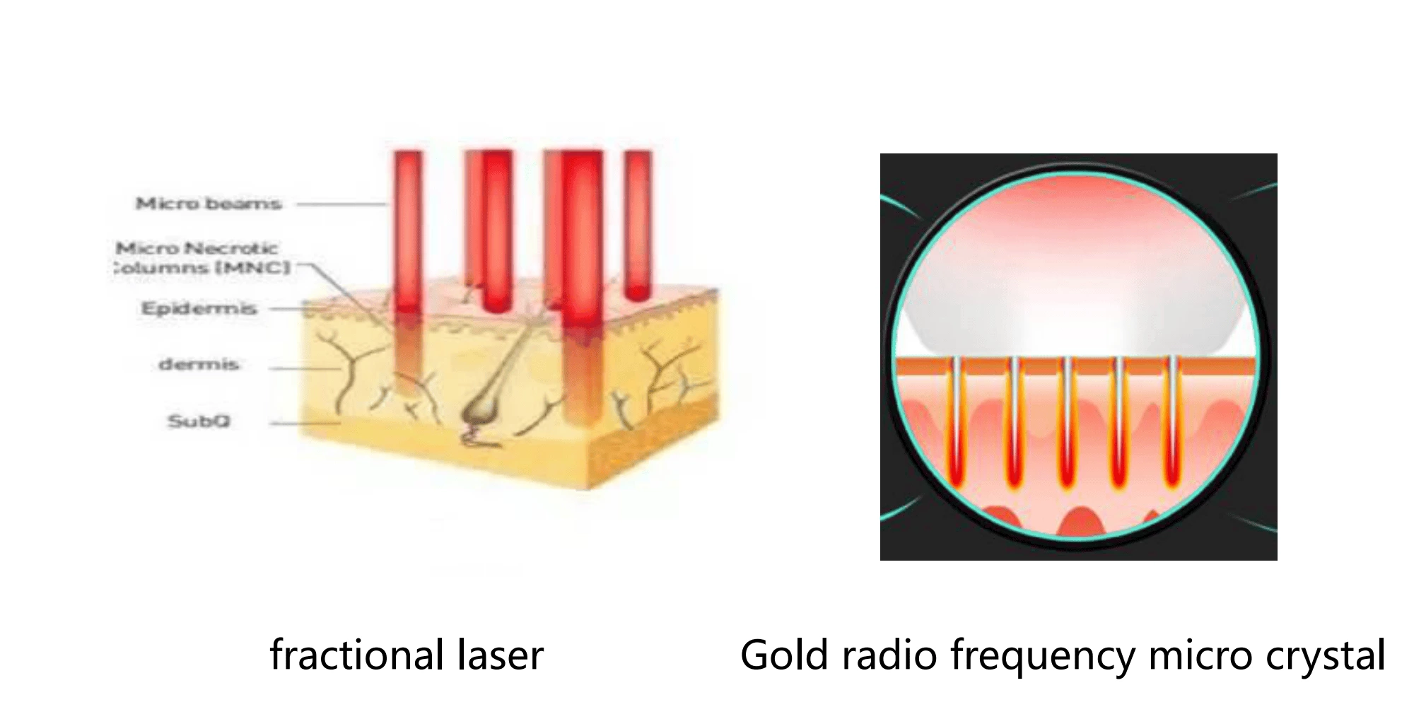 Stationary Gold Radio Frequency Microcrystal Needle Machine