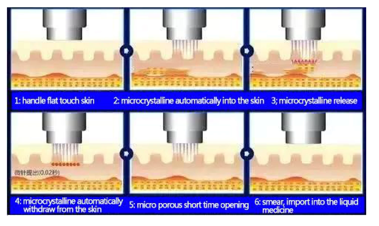 Stationary Gold Radio Frequency Microcrystal Needle Machine