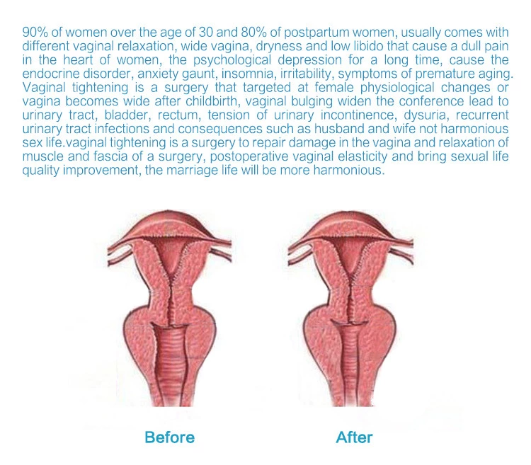 Co2 Fractional Laser Machine Wrinkle removal skin tightening