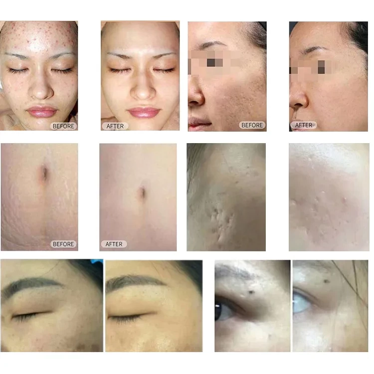 Co2 Fractional Laser Machine Wrinkle removal skin tightening